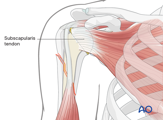 View of shoulder showing standard stem prosthesis and subscapularis tendon