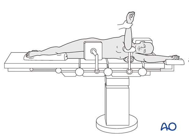 Lateral decubitus position – patient’s body is secured with padded side supports