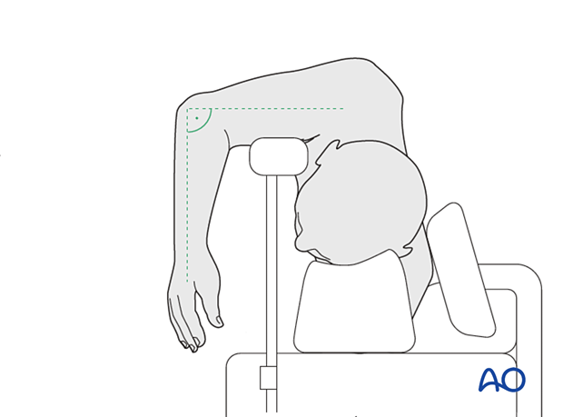 A modified lateral decubitus position, with the patient in a more oblique position