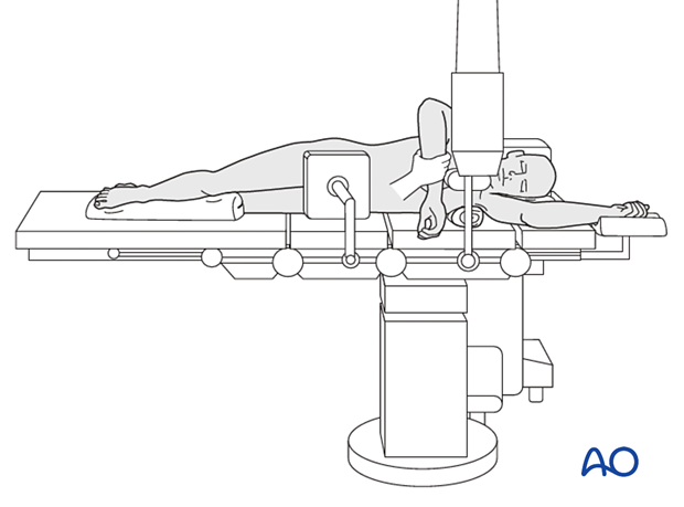 C-arm positioning for lateral images with the patient in lateral decubitus position