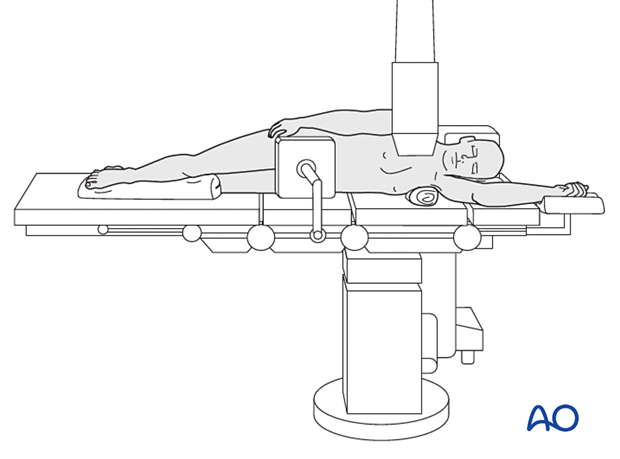 The C-arm is positioned from anterior to posterior