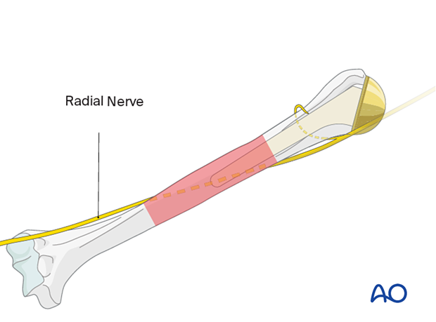 The position of the radial nerve must be considered when placing cerclage cables or wires around the humerus.