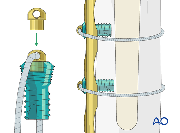 Peri-implant fixation options: Cerclage cables or wires should be used in conjunction with unicortical locking screws