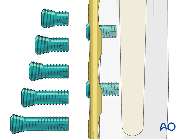 Peri-implant fixation options: unicortical locking screws