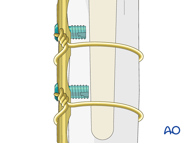 Peri-implant fixation options: unicortical locking screws may be used in conjunction with cerclage cables or wires