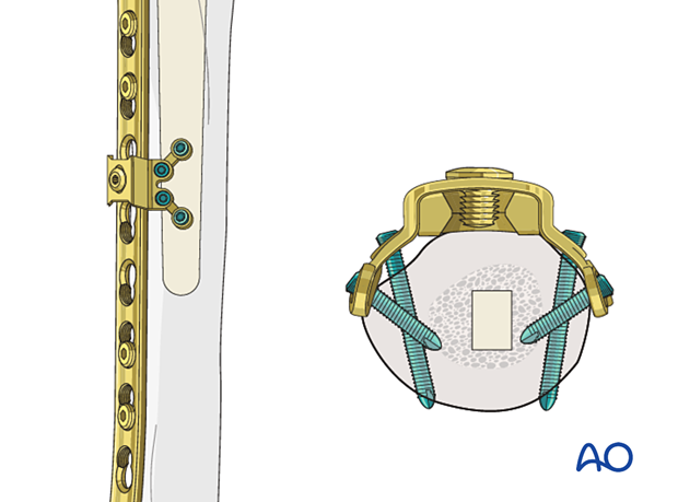 Peri-implant fixation options: Locking attachment plate