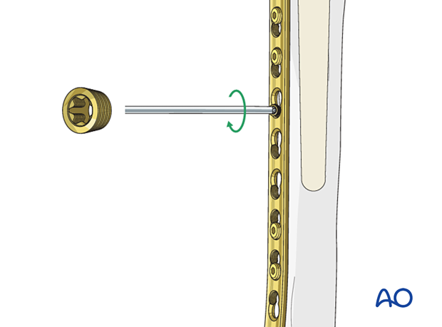 Peri-implant fixation options: The locking attachment plate is secured to the plate with a connection screw. The conical part of the screw is screwed to the plate.