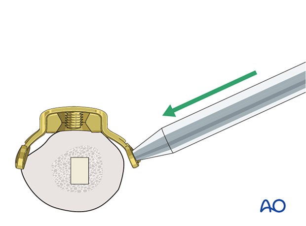 Peri-implant fixation options: The locking attachment plate can be pre-bent