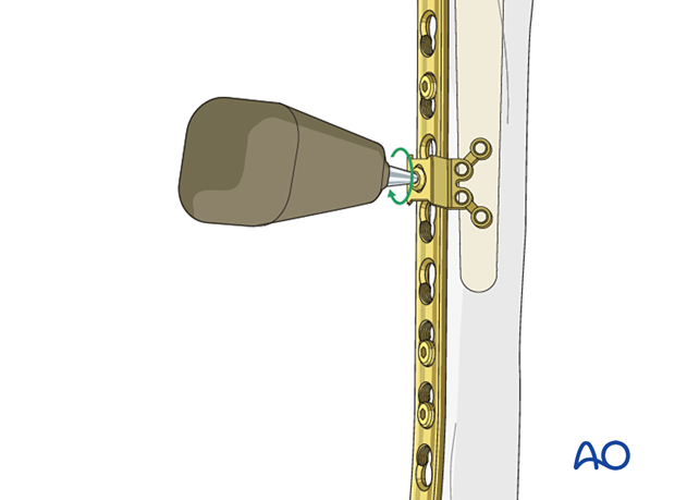 per 10 X100 Peri-implant fixation options