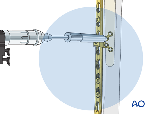 Peri-implant fixation options: The locking attachment plate – drilling screw holes