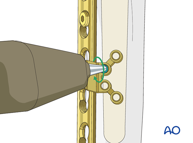 Peri-implant fixation options: The locking attachment plate – inserting locking screws