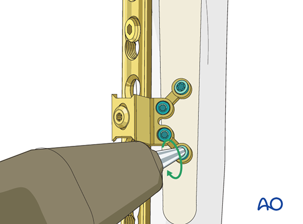 Peri-implant fixation options: The locking attachment plate – stabilizing the plate with additional locking screws.