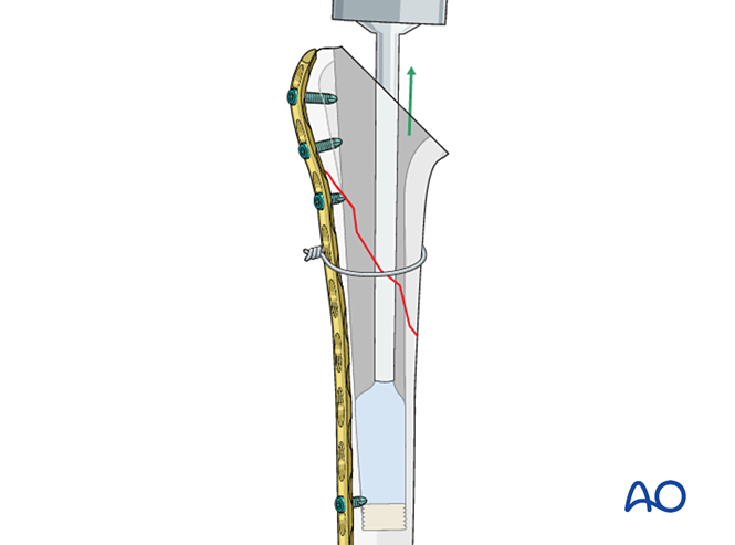 Stem Injection Riser Basic technique – cemented stem