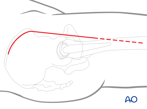 Skin incision for hip anterior (Iliofemoral or Smith-Petersen) approach