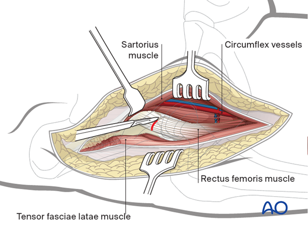 Identify, divide and ligate the lateral femoral circumflex vessels distally. Release the direct head of rectus femoris...