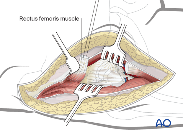 If necessary, fully release the indirect and direct head of rectus femoris
