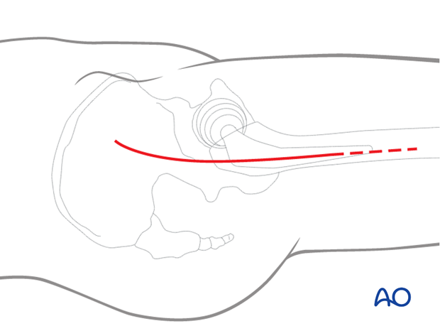Skin incision for hip anterolateral (Watson-Jones) approach