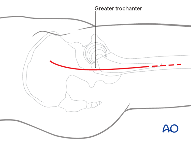 Distally, the incision extends along the femur about 10 cm below the greater trochanter