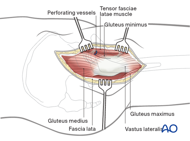 Expose the interval between the gluteus medius and the tensor fascia lata and extend it proximally over the hip joint