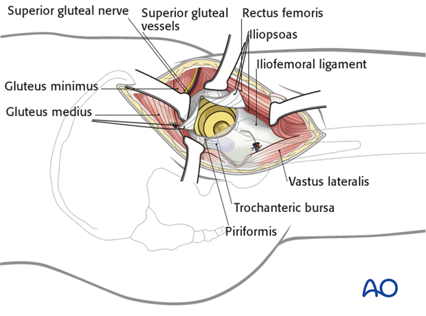 …and place two retraction sutures, anteriorly and posteriorly. Protect the acetabular labrum