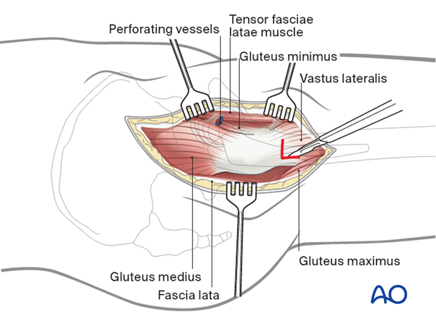 Vastus lateralis release to increase femur exposure