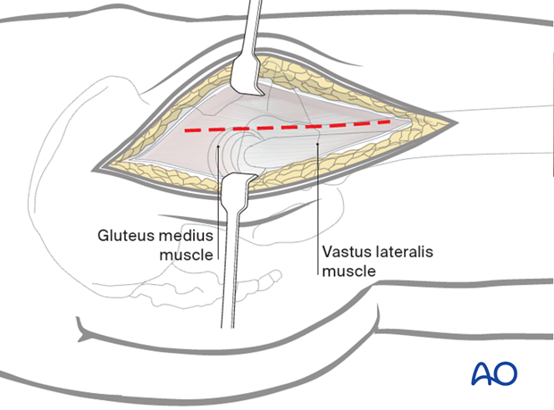 Divide the fascia lata over the greater trochanter, extending it distally over the proximal femoral shaft and proximally