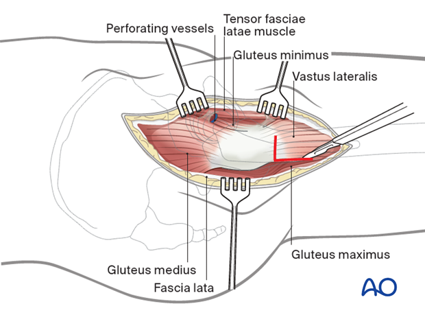 Vastus lateralis release to increase proximal femur exposure