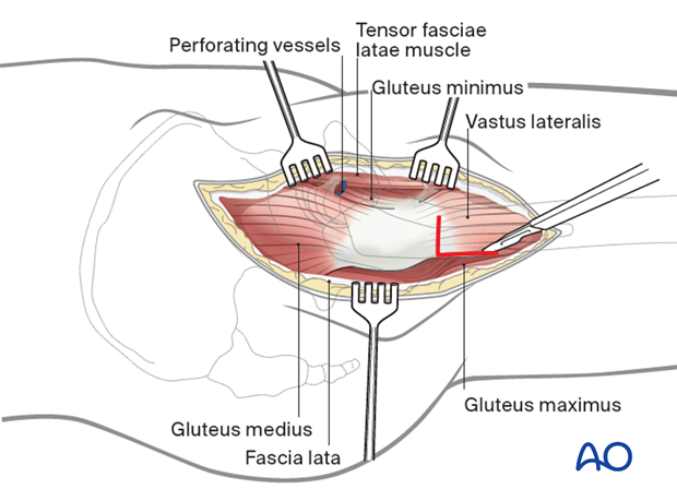 Tension band wiring for Trochanteric femoral fracture Tension band wiring for Trochanteric femoral fracture