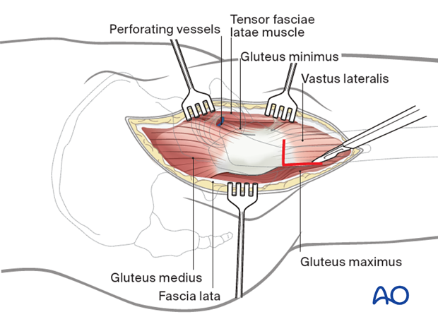 Direct lateral approach extension