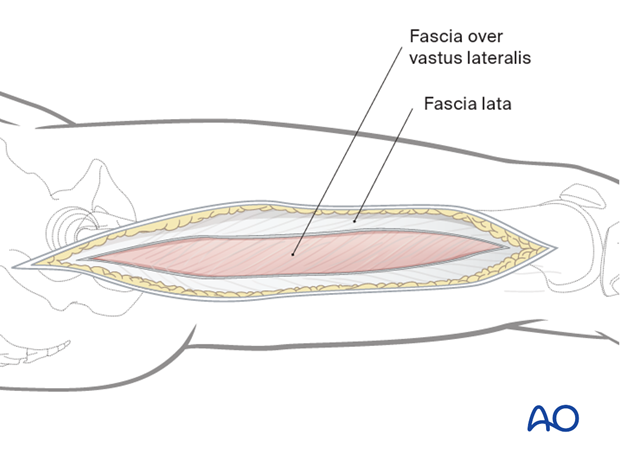 Opening the fascia lata