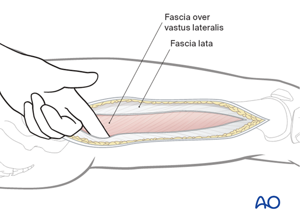 Vastus lateralis fascia lata separation
