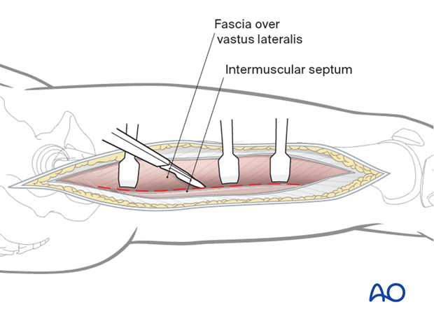 Incision fascia vastus lateralis