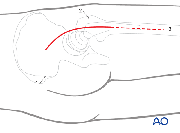 Skin incision