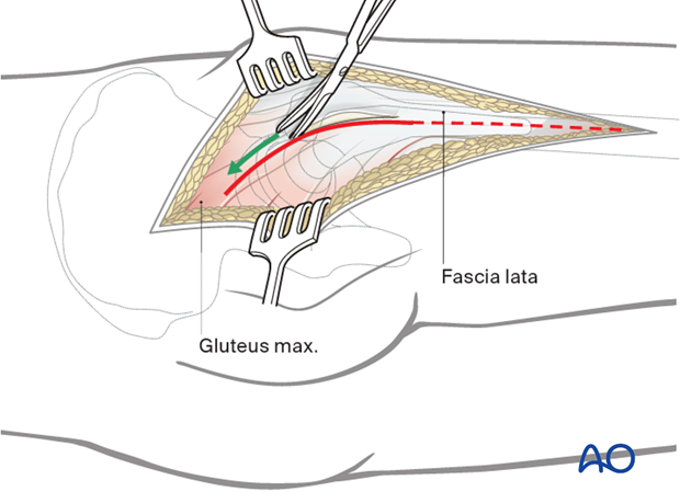 Dissection of fascia lata