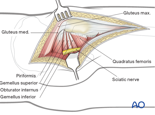Protection of sciatic nerve