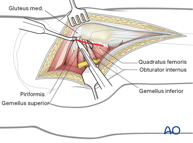 Exposure of short rotator tendons