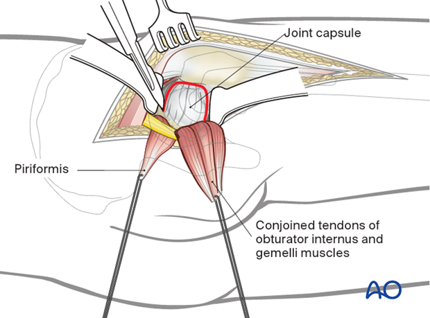 Posterior blunt dissection