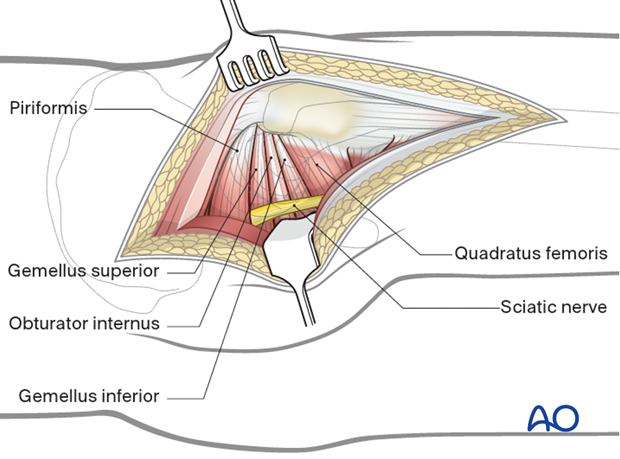 Deep dissection in a Kocher-Langenbeck approach to the hip