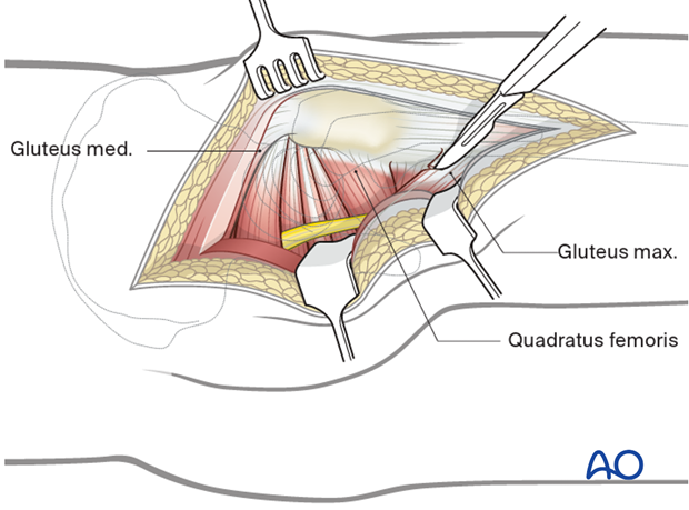 Gluteus maximus detachment in a Kocher-Langenbeck approach to the hip