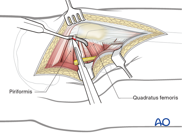 External rotators detachment in a Kocher-Langenbeck approach to the hip