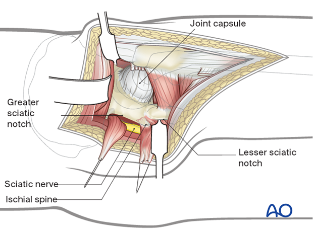 Exposure of the posterior wall and column in a Kocher-Langenbeck approach to the hip