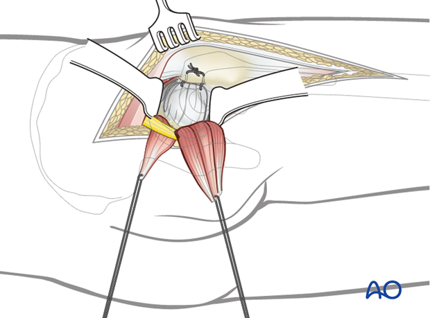 Wound closure in a Kocher-Langenbeck approach to the hip
