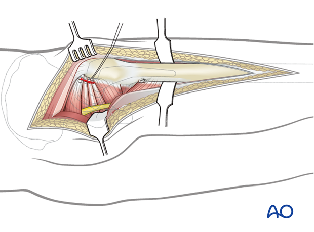 Distal extension to a Kocher-Langenbeck approach to the hip