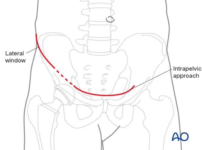 Intrapelvic Anterior intrapelvic approach to the acetabulum