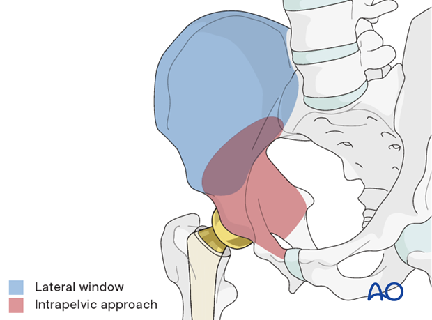 Exposure with an anterior intrapelvic approach
