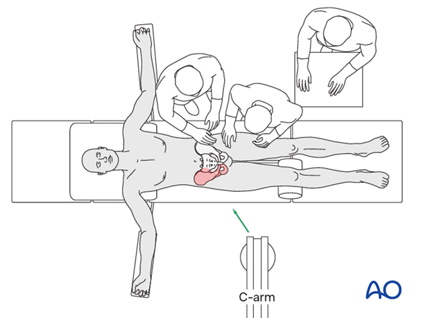 Patient setup for an anterior intrapelvic approach
