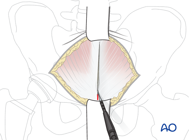 Superficial dissection for an anterior intrapelvic approach