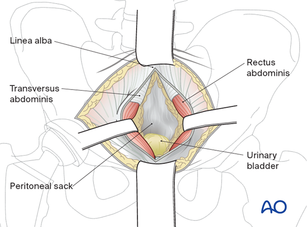 Deep dissection for an anterior intrapelvic approach
