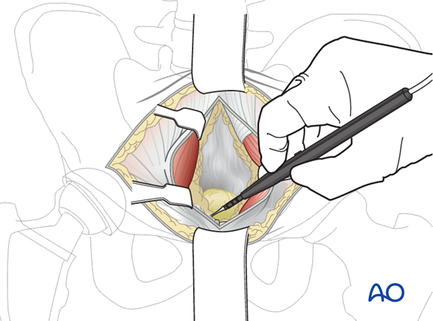 Superior pubic ramus identification and exposure