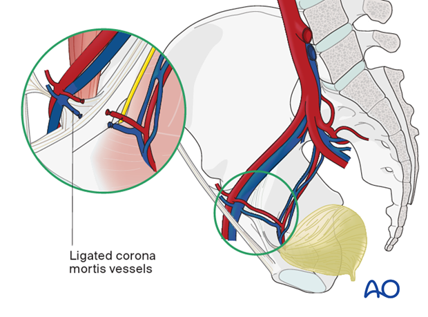 Corona mortis vessels ligation